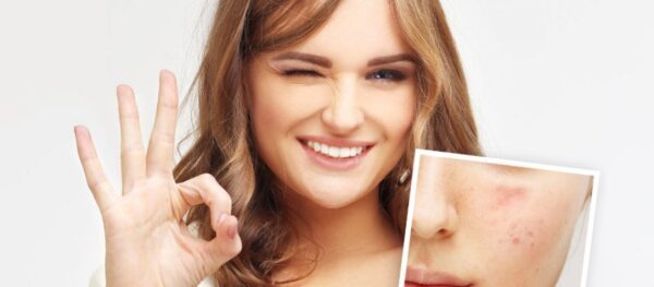 Clear Skin for Pakistani Women: Top Acne-Fighting Ingredients