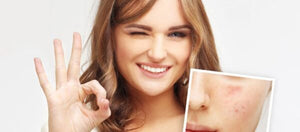 Clear Skin for Pakistani Women: Top Acne-Fighting Ingredients